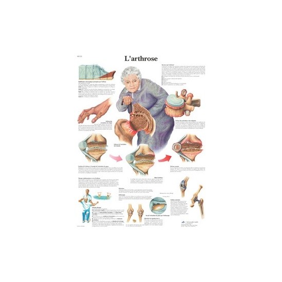 Planche anatomique arthrose
